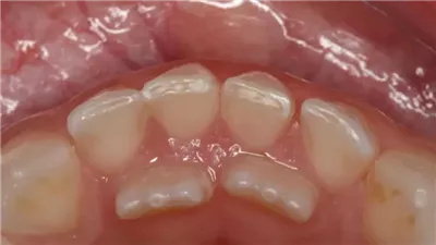 دواء ياباني جديد يعيد نمو الأسنان الپشرية