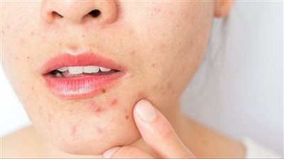 The Benefits of Moisturizer for Oily Skin