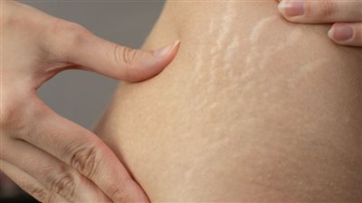Best Natural Oils for Stretch Mark Reduction