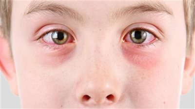 Pink eye outbreak spreads in Asia: How to protect yourself