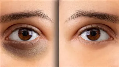 Goodbye Dark Circles: Effective Solutions to Get Rid of Them