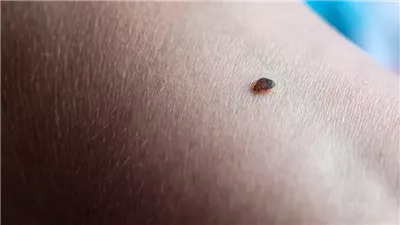تخلص من بق الڤراش بخطوات بسيطة
