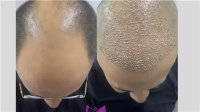 زراعة الشعر .. الحل النهائي لتساقط الشعر