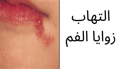 تشقق زوايا الفم : الأسباب والأعراض والعلاج
