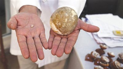 مشروب يمنع حصوات الكلى