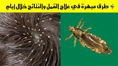 تخلص من القمل في خطوات بسيطة