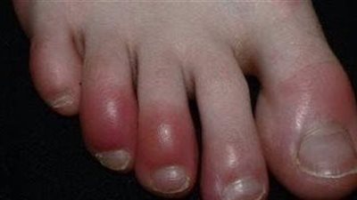 علامات في قدميك تخبرك أن كبدك في ورطة